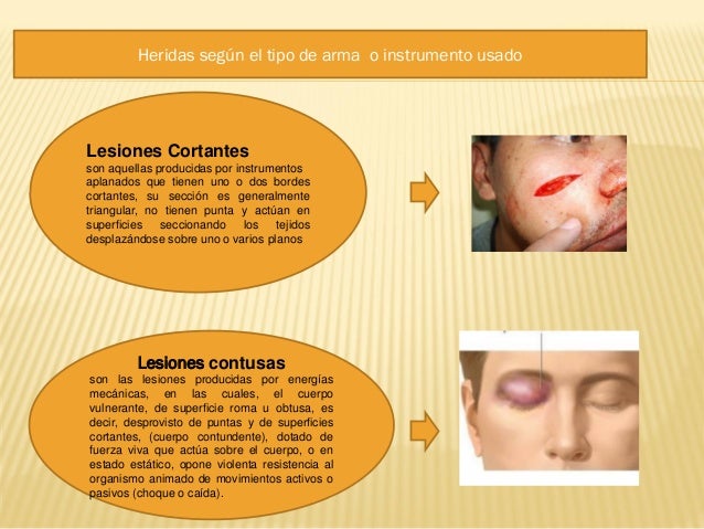 lesiones contusas medicina legal